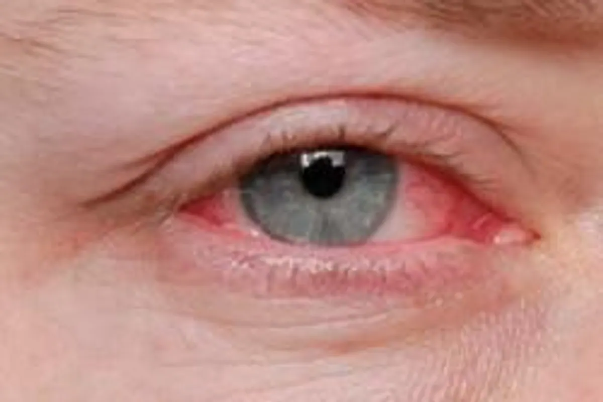 Personne ajustant délicatement une monture de lunettes près de la tempe pour éviter une zone cutanée irritée.
